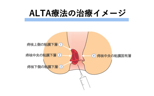 ALTA療法の治療イメージ